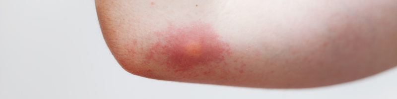 Afinal, o que é a doença de Chagas?